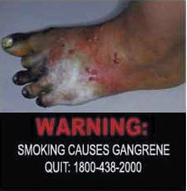Singapore 2006 Health Effects vascular system - gangrene, diseased organ, gross